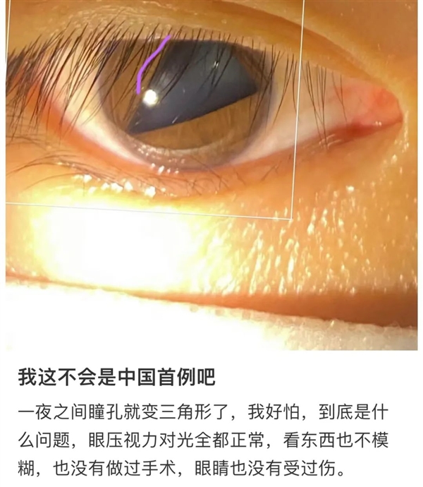 救命！瞳孔突然变成三角形：真的是新冠后遗症吗？