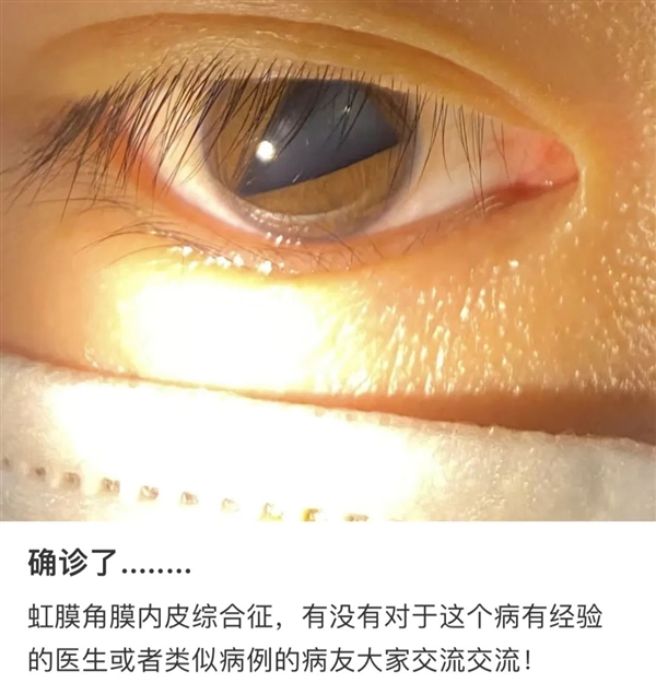 救命！瞳孔突然变成三角形：真的是新冠后遗症吗？
